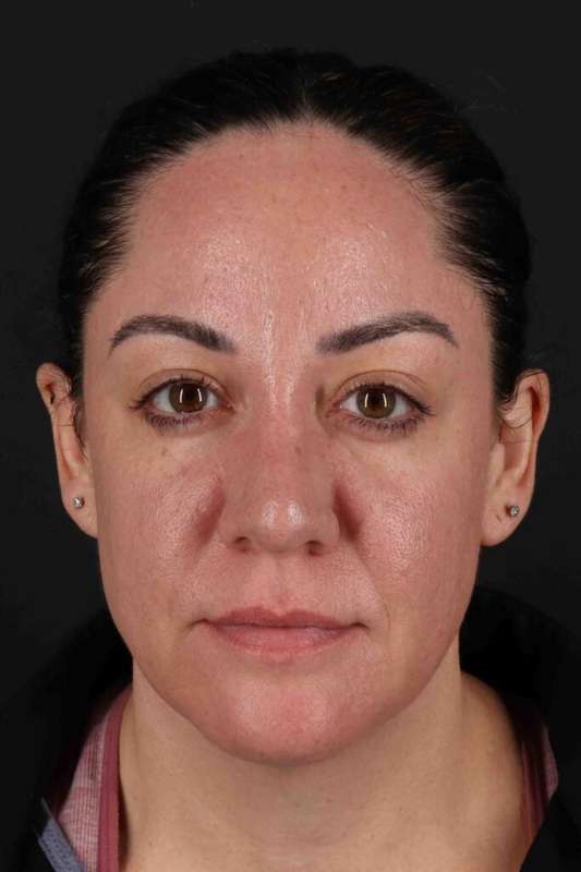 Brow Lift Before & After Patient #4733