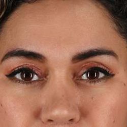 Brow Lift Before & After Patient #4744