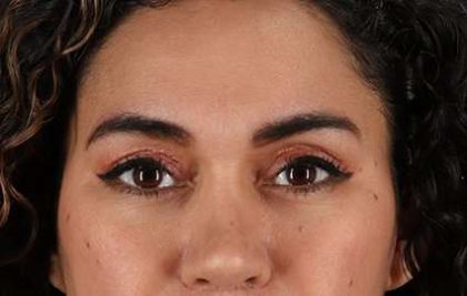 Brow Lift Before & After Patient #4744