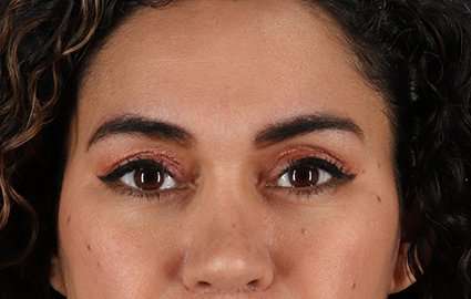 Brow Lift Before & After Patient #4744