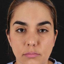 Brow Lift Before & After Patient #4755