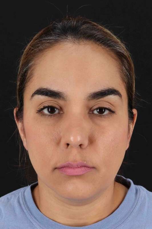 Brow Lift Before & After Patient #4755