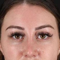 Brow Lift Before & After Patient #4766