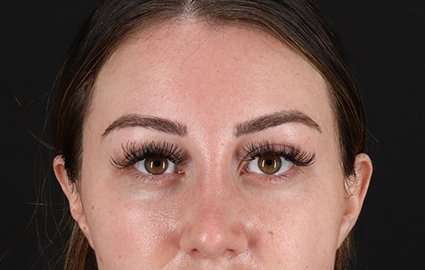 Brow Lift Before & After Patient #4766