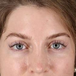 Brow Lift Before & After Patient #4777