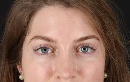 Brow Lift Before & After Patient #4777