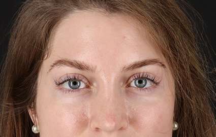Brow Lift Before & After Patient #4777