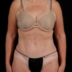 Abdominoplasty (Tummy Tuck) Before & After Patient #1029