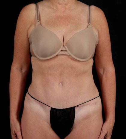 Abdominoplasty (Tummy Tuck) Before & After Patient #1029