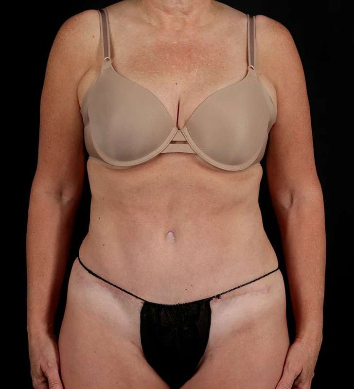 Abdominoplasty (Tummy Tuck) Before & After Patient #1029