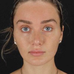 Brow Lift Before & After Patient #4799