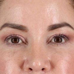 Brow Lift Before & After Patient #4843