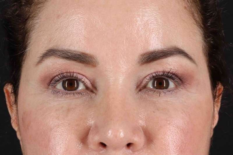 Brow Lift Before & After Patient #4843