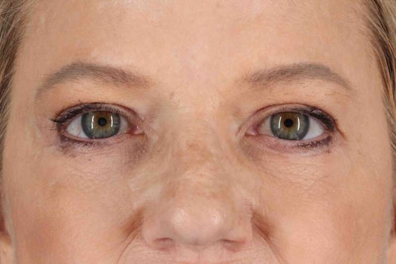 Brow Lift Before & After Patient #4854