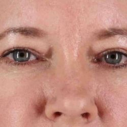 Brow Lift Before & After Patient #4865