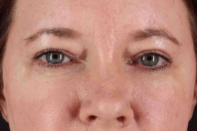 Brow Lift Before & After Patient #4865