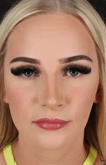 Brow Lift Before & After Patient #4876