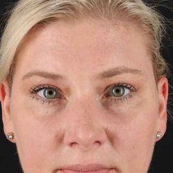 Brow Lift Before & After Patient #4879