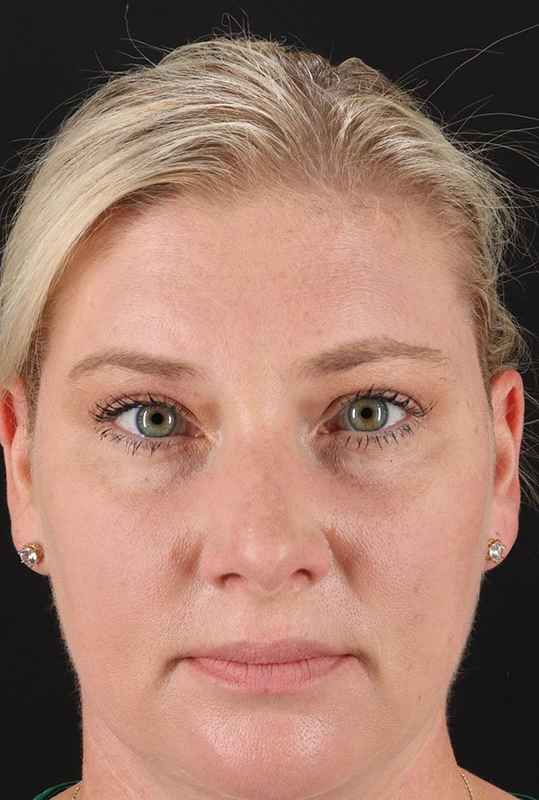 Brow Lift Before & After Patient #4879