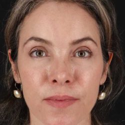 Brow Lift Before & After Patient #4890