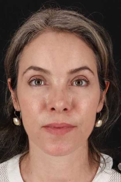 Brow Lift Before & After Patient #4890