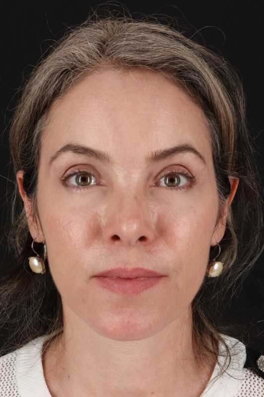 Brow Lift Before & After Patient #4890