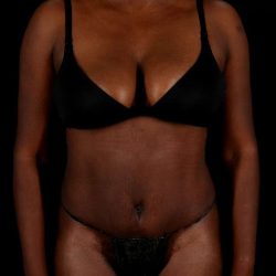 Abdominoplasty (Tummy Tuck) Before & After Patient #1045