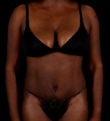 Abdominoplasty (Tummy Tuck) Before & After Patient #1045