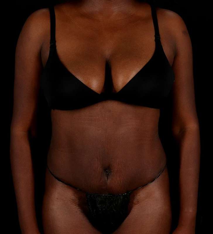 Abdominoplasty (Tummy Tuck) Before & After Patient #1045