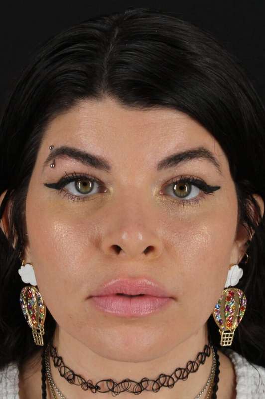 Brow Lift Before & After Patient #4912