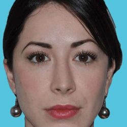 Chin Surgery Before & After Patient #4928