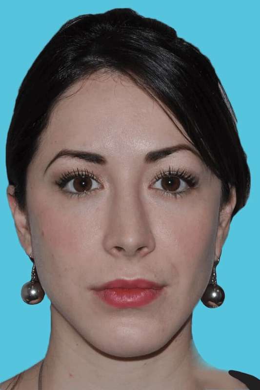 Chin Surgery Before & After Patient #4928