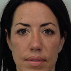 Chin Surgery Before & After Patient #4936