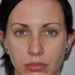 Chin Surgery Before & After Patient #4944