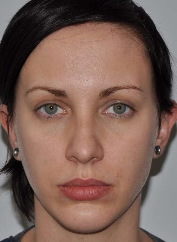 Chin Surgery Before & After Patient #4944