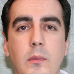 Chin Surgery Before & After Patient #4949