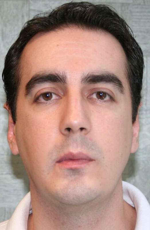 Chin Surgery Before & After Patient #4949