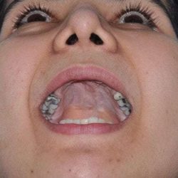 Cleft Lip Palate Before & After Patient #4952