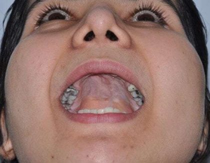 Cleft Lip Palate Before & After Patient #4952