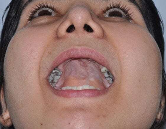 Cleft Lip Palate Before & After Patient #4952