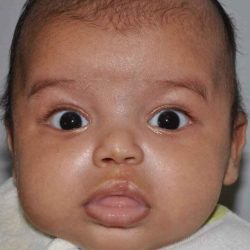 Cleft Lip Palate Before & After Patient #4955