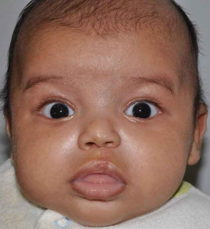 Cleft Lip Palate Before & After Patient #4955
