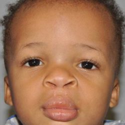 Cleft Lip Palate Before & After Patient #4961