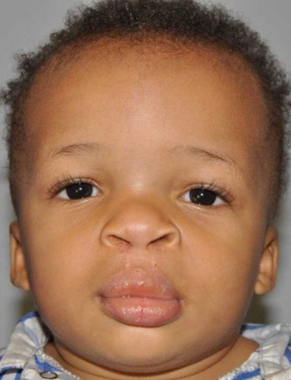 Cleft Lip Palate Before & After Patient #4961