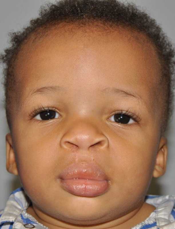 Cleft Lip Palate Before & After Patient #4961
