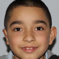 Cleft Lip Palate Before & After Patient #4964