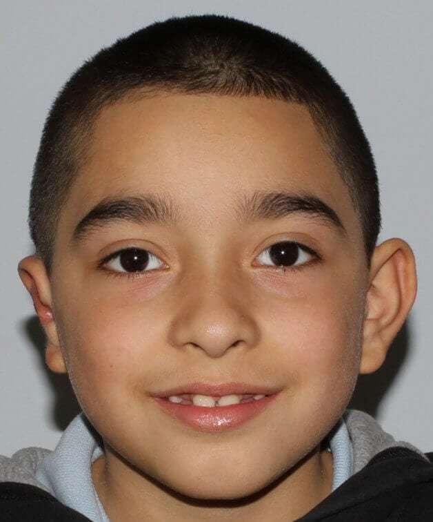 Cleft Lip Palate Before & After Patient #4964