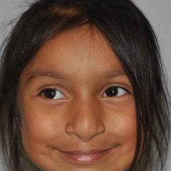 Cleft Lip Palate Before & After Patient #4973