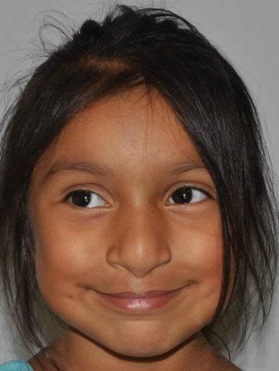 Cleft Lip Palate Before & After Patient #4973