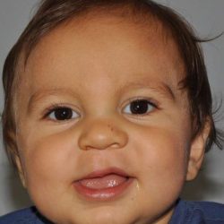 Cleft Lip Palate Before & After Patient #4976